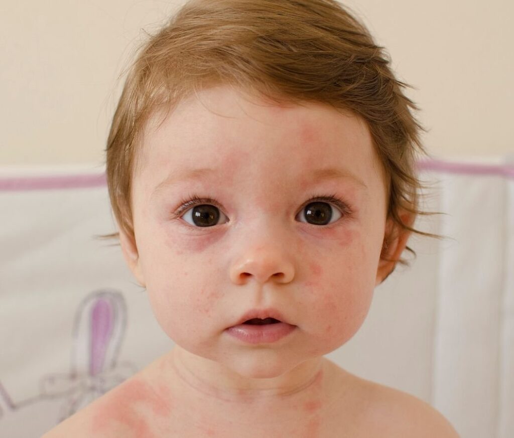 Kid With Rash