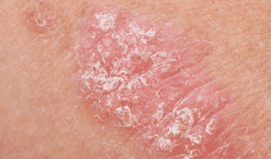 diagnose and treat psoriasis