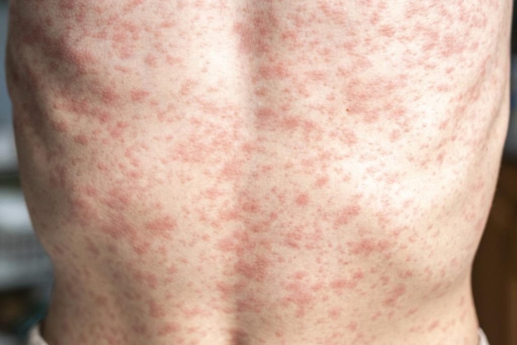 Measles rash