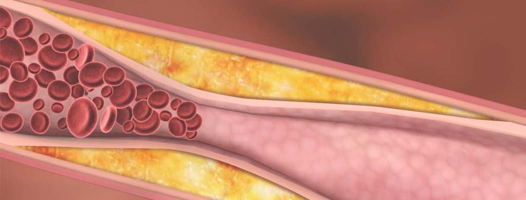 understanding hyperlipidemia