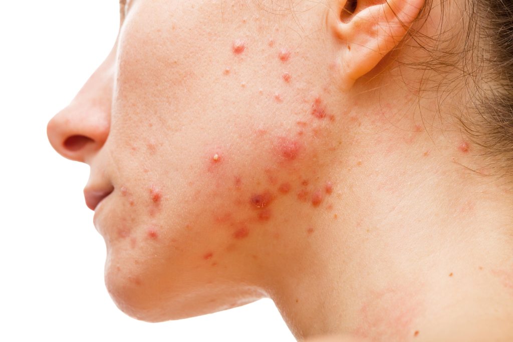 Understanding acne