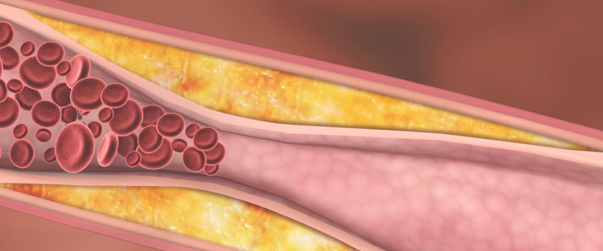 understanding hyperlipidemia