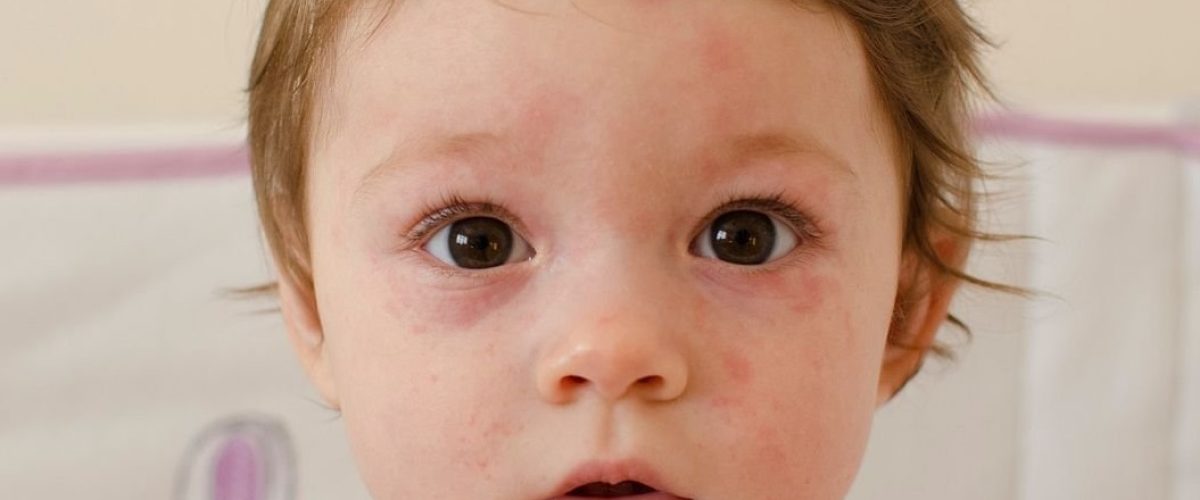 Kid With Rash