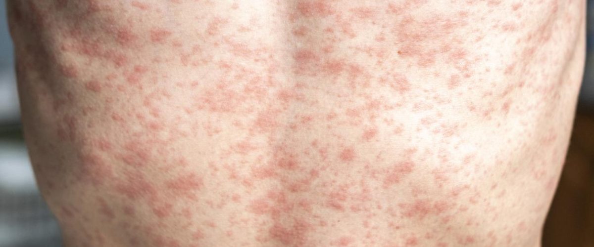 Measles rash