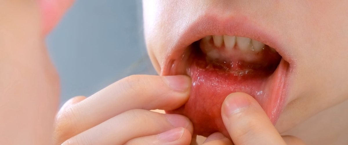 Oral Cancer Awareness Month