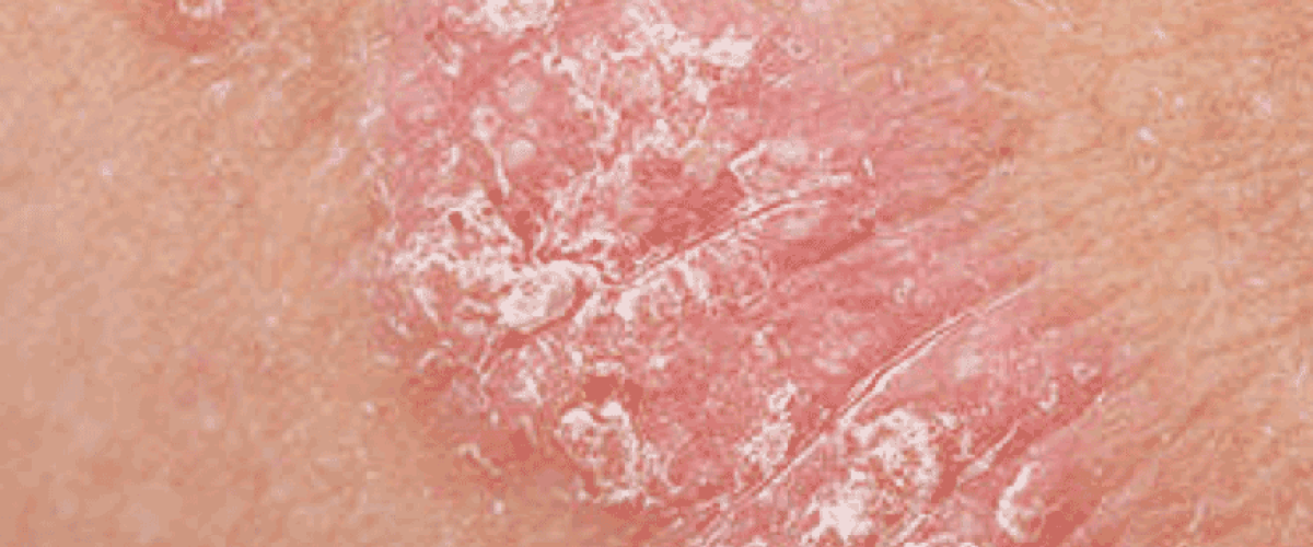 diagnose and treat psoriasis